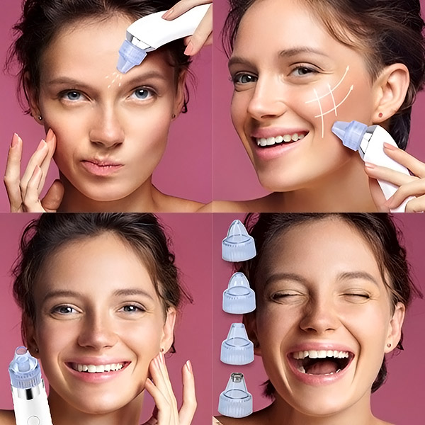 Hudforyngelse med KILPOR